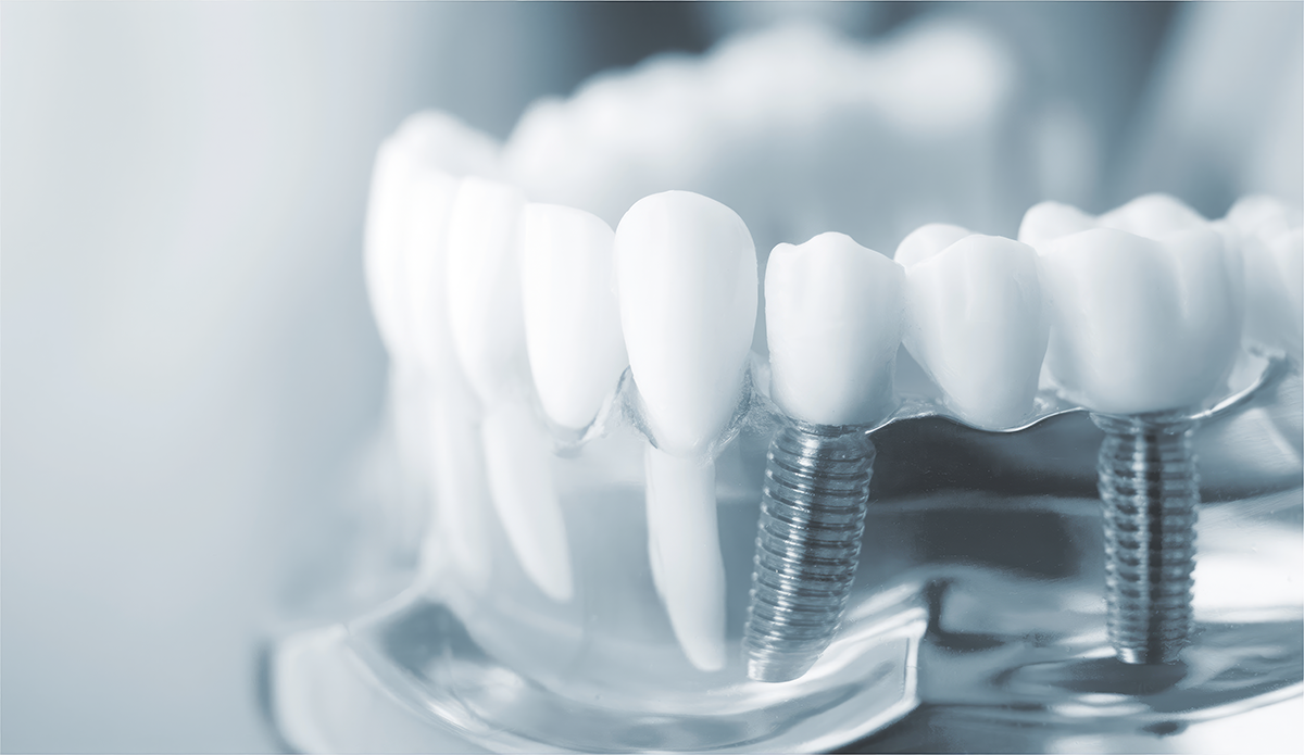 Aplicație dentară pentru prelucrare de precizie